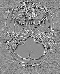 Cerebral cavernous venous malformation (Radiopaedia 70008-80021 G 8).jpg