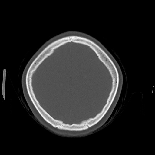 Cerebral cavernous venous malformation (Radiopaedia 70008-80022 Axial bone window 44).jpg