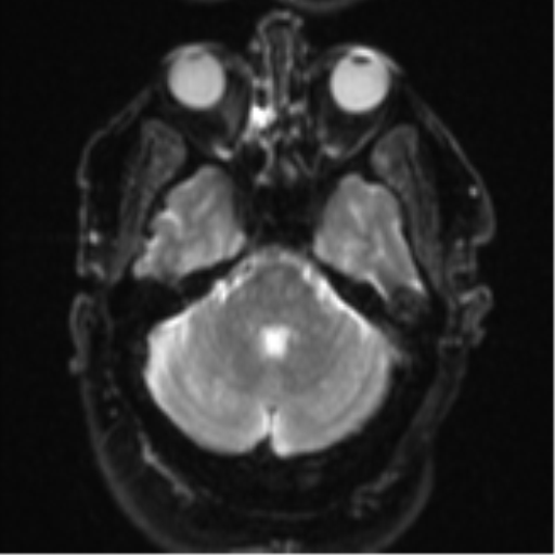 File:Cerebral embolic infarcts (embolic shower) (Radiopaedia 57395-64342 Axial DWI 10).png