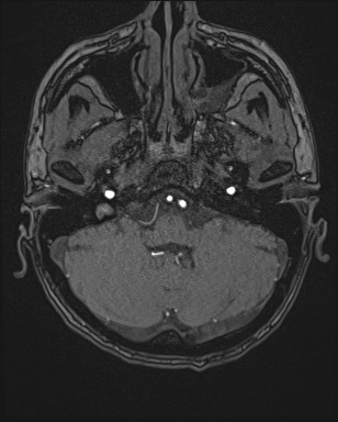 Cerebral embolic infarcts (embolic shower) (Radiopaedia 72391-82921 Axial MRA 14).jpg