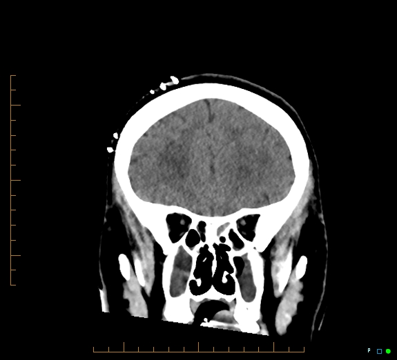 Cerebral fat embolism (Radiopaedia 85521-101220 Coronal non-contrast 19).jpg