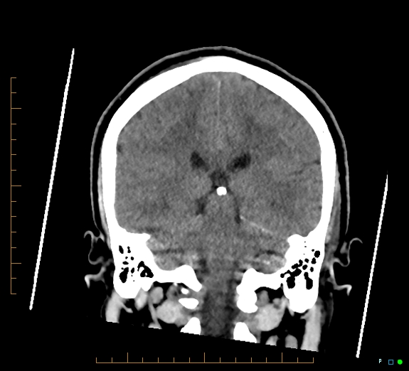 Cerebral fat embolism (Radiopaedia 85521-101220 Coronal non-contrast 40).jpg