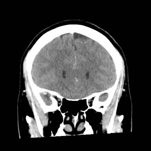 Cerebral hemorrhage secondary to arteriovenous malformation (Radiopaedia 33497-34561 C 21).png