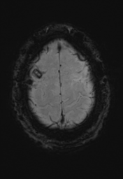 File:Cerebral hemorrhagic contusions- temporal evolution (Radiopaedia 40224-42757 D 35).png