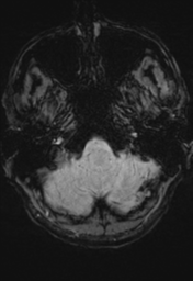 File:Cerebral hemorrhagic contusions- temporal evolution (Radiopaedia 40224-42757 D 4).png