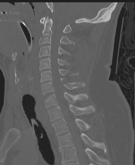 Cerebral hemorrhagic contusions and cervical spine fractures (Radiopaedia 32865-33841 Sagittal bone window 54).jpg