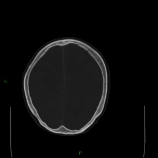 Cerebral metastases - breast primary (Radiopaedia 77653-89857 Axial bone window 86).jpg