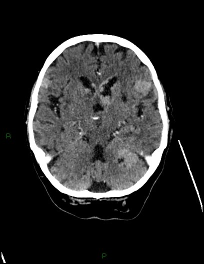 Cerebral metastases - ependymal and parenchymal (Radiopaedia 79877-93131 Axial C+ delayed 31).jpg