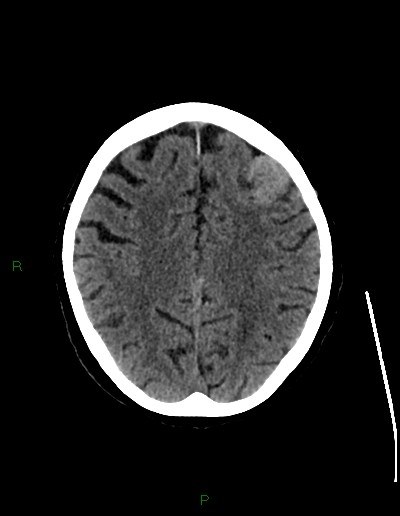 File:Cerebral metastases - ependymal and parenchymal (Radiopaedia 79877-93131 Axial non-contrast 55).jpg