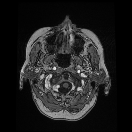 Cerebral metastases - melanoma (Radiopaedia 80972-94522 Axial T1 C+ 21).jpg