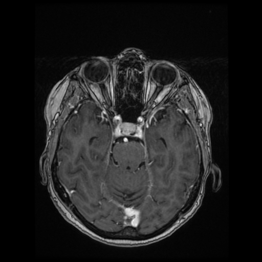 Cerebral metastases - melanoma (Radiopaedia 80972-94522 Axial T1 C+ 44).jpg