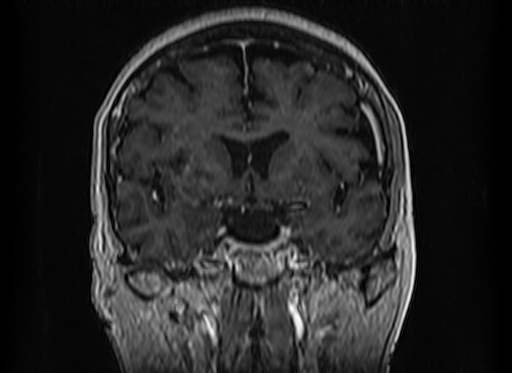 File:Cerebral metastases from lung cancer with amyloid angiopathy and cerebellopontine angle meningioma (Radiopaedia 74306-85191 Coronal T1 C+ 25).jpg