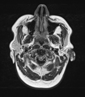 File:Cerebral metastases mimicking abscesses (Radiopaedia 45841-50131 Axial FLAIR 2).png