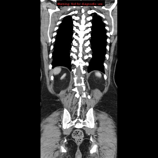 Cerebral metastasis - colorectal carcinoma (Radiopaedia 8581-83548 A 68).jpg