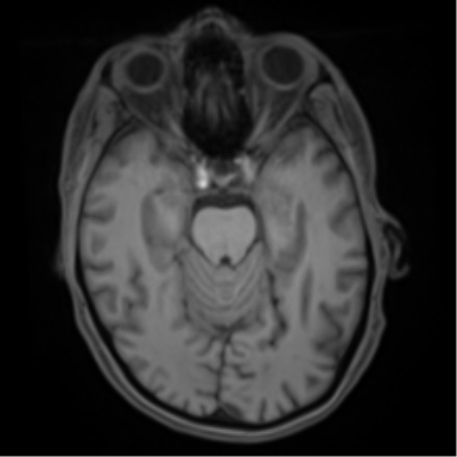 File:Cerebral metastasis - melanoma (Radiopaedia 54718-60954 Axial T1 20).png