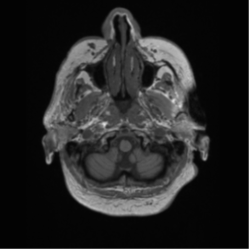 Cerebral metastasis to basal ganglia (Radiopaedia 81568-95413 Axial T1 5).png