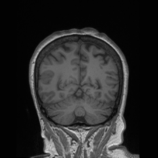 Cerebral metastasis to basal ganglia (Radiopaedia 81568-95413 Coronal T1 4).png