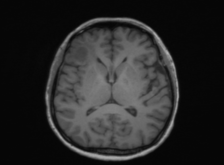Cerebral ring enhancing lesions - cerebral metastases (Radiopaedia 44922-48817 Axial T1 219).jpg