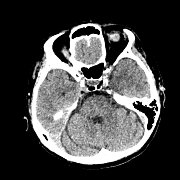 Cerebral ring enhancing lesions - cerebral metastases (Radiopaedia 44922-48818 Axial non-contrast 37).jpg
