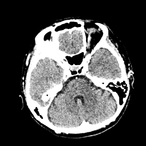 Cerebral ring enhancing lesions - cerebral metastases (Radiopaedia 44922-48818 B 90).jpg