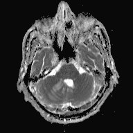 File:Cerebral toxoplasmosis (Radiopaedia 43956-47461 Axial ADC 5).jpg