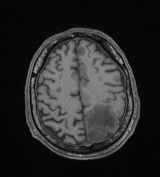 Cerebral toxoplasmosis (Radiopaedia 43956-47461 Axial T1 62).jpg