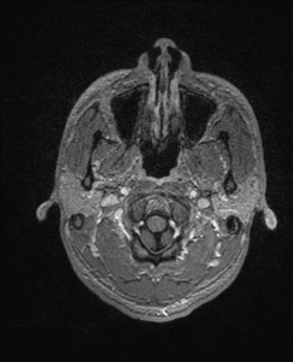Cerebral toxoplasmosis (Radiopaedia 85779-101597 Axial T1 C+ 13).jpg