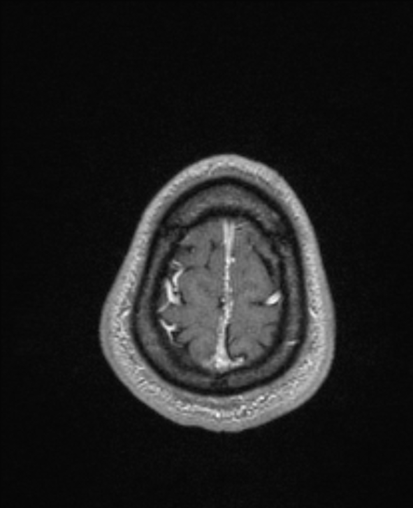 Cerebral toxoplasmosis (Radiopaedia 85779-101597 Axial T1 C+ 148).jpg