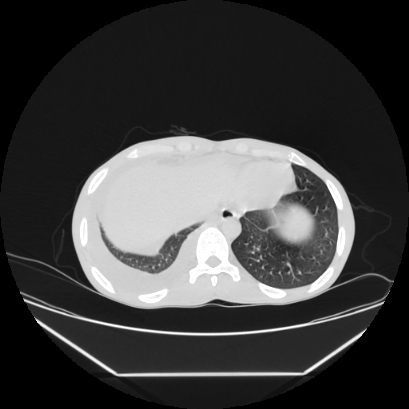 Cerebral tuberculoma (Radiopaedia 80829-94318 Axial lung window 156).jpg
