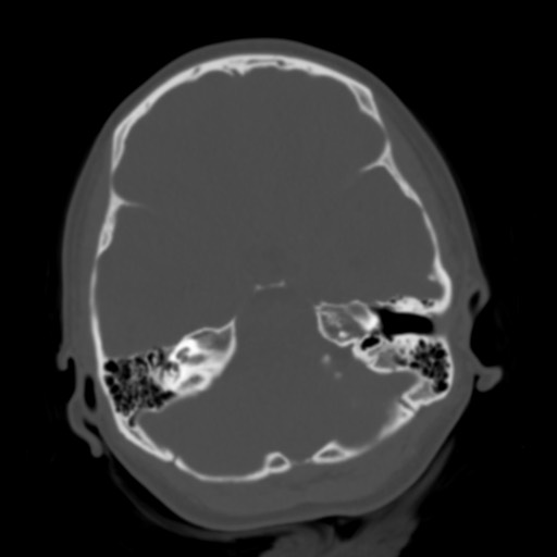 File:Cerebral tuberculosis with dural sinus invasion (Radiopaedia 60353-68018 Axial bone window 13).jpg