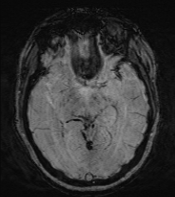 Cerebral venous infarct (Radiopaedia 53627-59685 Axial SWI 24).jpg