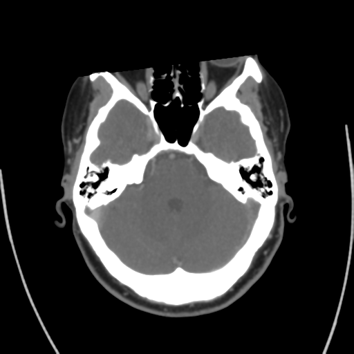Cerebral venous infarct related to dural venous sinus thromboses (Radiopaedia 35292-36804 Axial C+ delayed 15).png