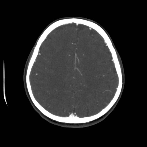 Cerebral venous sinus thrombosis (Radiopaedia 40619-43227 A 164).jpg