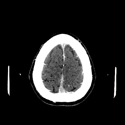 File:Cerebral venous thrombosis (CVT) (Radiopaedia 77524-89685 Axial with contrast 33).jpg