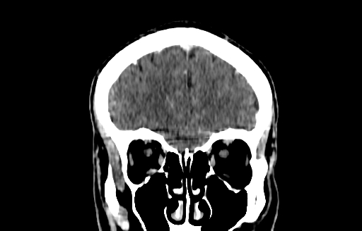 File:Cerebral venous thrombosis (CVT) (Radiopaedia 77524-89685 C 11).jpg