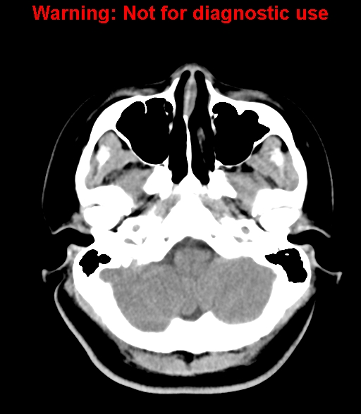 File:Cerebral venous thrombosis (Radiopaedia 37224-38992 Axial non-contrast 5).jpg