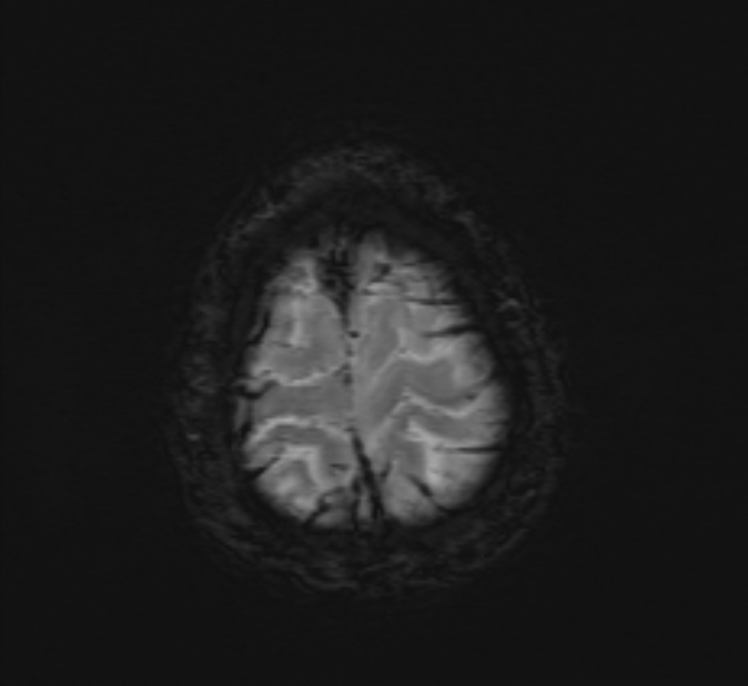Cerebral venous thrombosis (Radiopaedia 71207-81504 Axial SWI 50).jpg
