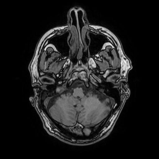 File:Cerebral venous thrombosis with secondary intracranial hypertension (Radiopaedia 89842-106957 Axial T1 48).jpg