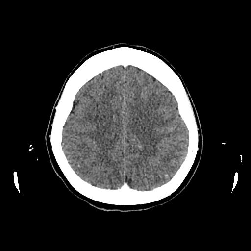 Cerebral venous thrombosis with venous hemorrhagic infarct (Radiopaedia 90354-107660 Axial with contrast 123).jpg