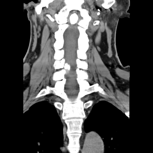 File:Cervical canal stenosis due to ossification of the posterior longitudinal ligament (Radiopaedia 47260-51823 Axial non-contrast 1).png