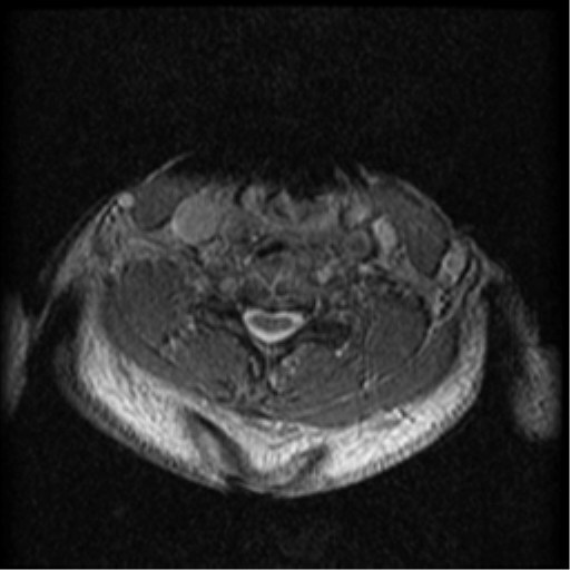 File:Cervical canal stenosis with cord compression (Radiopaedia 34114-35374 Axial Gradient Echo 37).png
