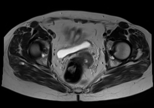 File:Cervical carcinoma (Radiopaedia 88312-104943 Sagittal T1 14).jpg