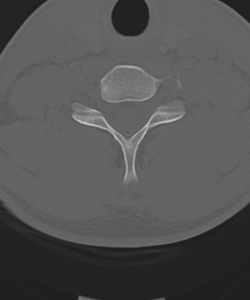 Cervical intercalary bone (Radiopaedia 35211-36748 Axial bone window 46).png