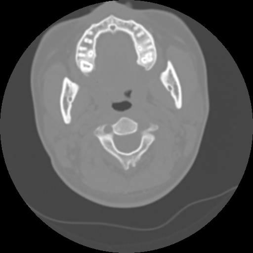 File:Cervical rib (Radiopaedia 71110-81363 Axial non-contrast 22).jpg