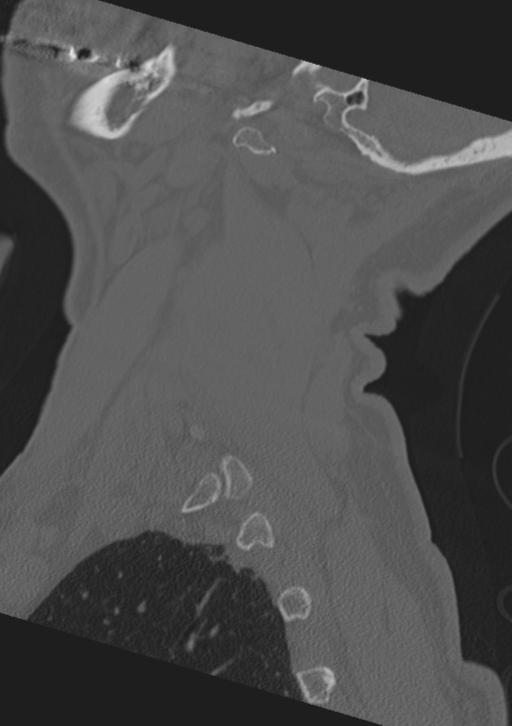 Cervical spine fractures with vertebral artery dissection (Radiopaedia 53296-59268 Sagittal bone window 61).png