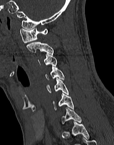 Cervical spondylodiscitis (Radiopaedia 28057-29489 Sagittal bone window 43).jpg