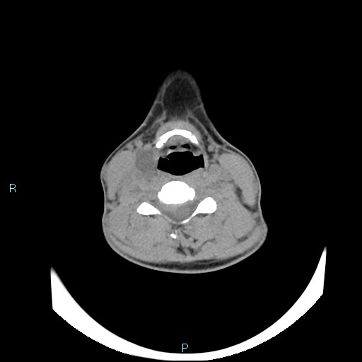 Cervical thymic cyst (Radiopaedia 88632-105335 Axial non-contrast 59).jpg