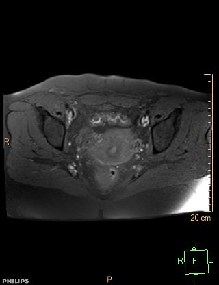 File:Cesarian scar endometriosis (Radiopaedia 68495-78066 Axial T1 fat sat 15).jpg