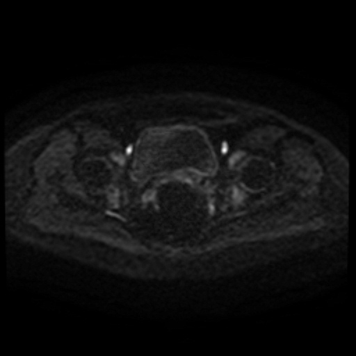 Cesarian section scar endometriosis (Radiopaedia 66520-75799 Axial DWI 92).jpg