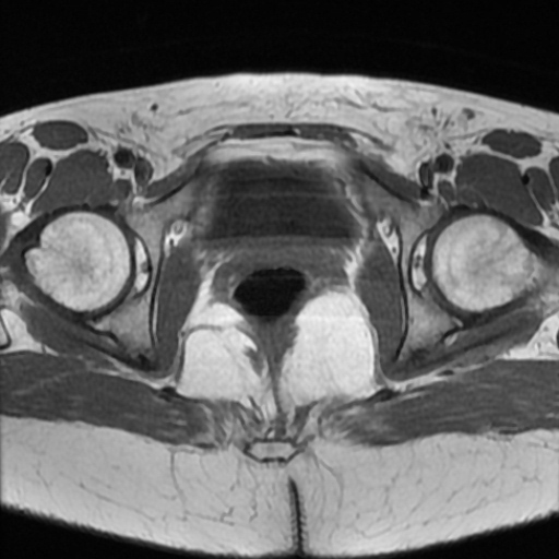 File:Cesarian section scar endometriosis (Radiopaedia 66520-75799 Axial T1 20).jpg